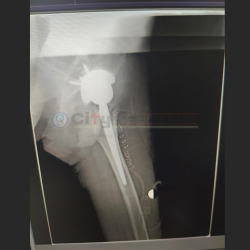 best hip replacement hospital in indore