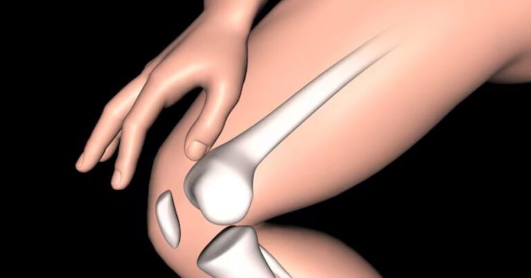 best knee replacement surgeon in Indore