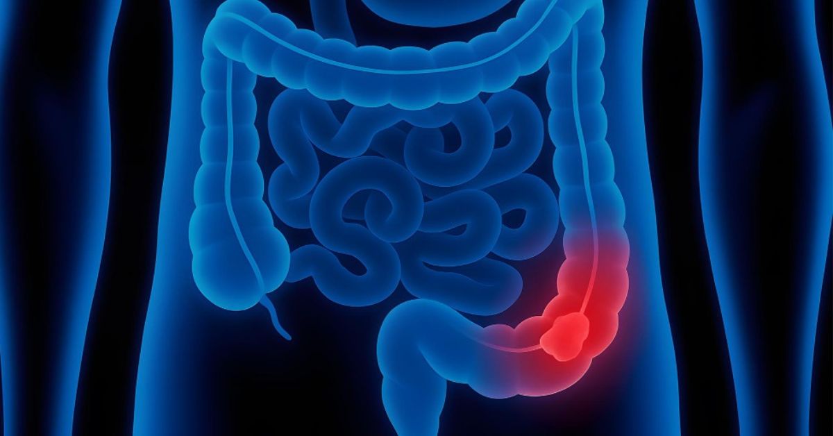 Appendix Kya Hai? Causes, Symptoms aur Best Treatment Options
