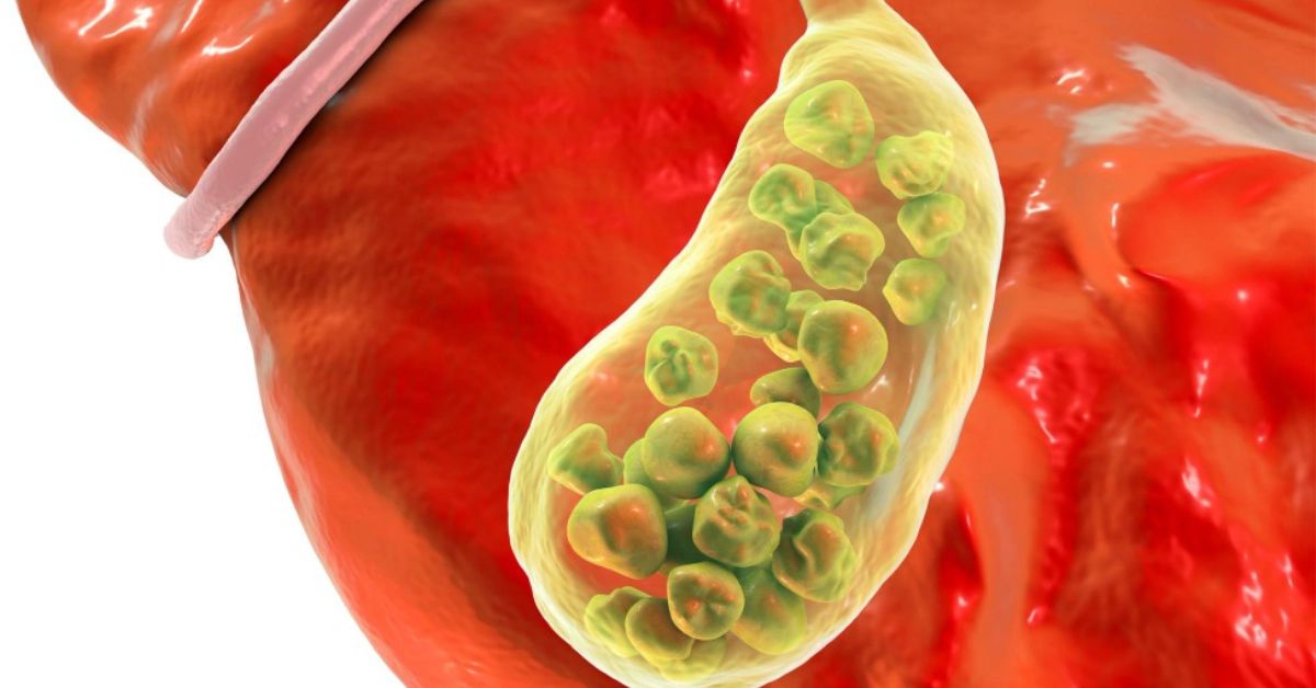 Gall Bladder Stone Kya Hai? Causes, Symptoms aur Best Treatment