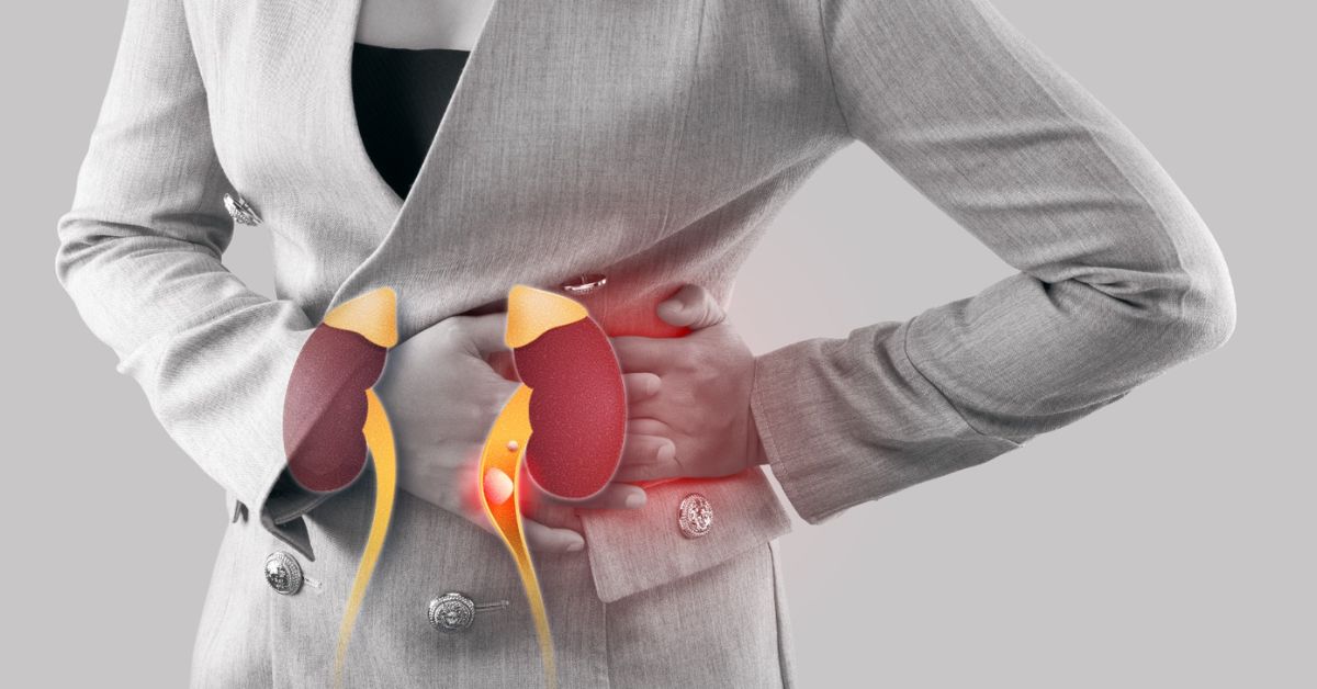 Kidney Stone Treatment: Causes, Symptoms, and Best Solutions
