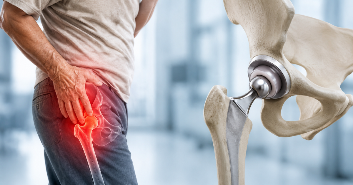 How Do You Know If You Need Hip Replacement Surgery?