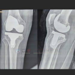 knee replacement hospital in indore