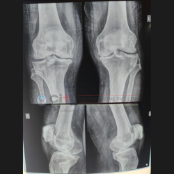 total knee replacement hospital in indore